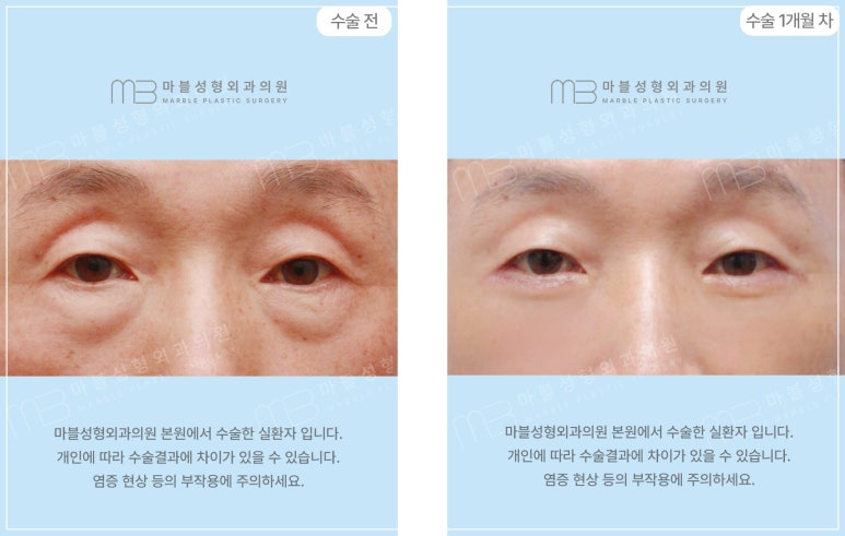 Differences in Lower Eyelid Surgery by Age Group and Recommended Methods: Showing Your Parents Appreciation Through Lower Eyelid Surgery (Before-and-After Photos O) @ Marble Plastic Surgery Clinic image 6
