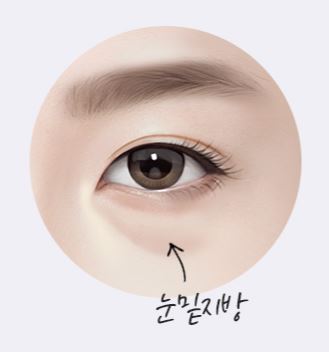 눈밑지방재배치 자연스럽게 다크서클 개선해볼까!마블성형외과의원 관련 이미지 1