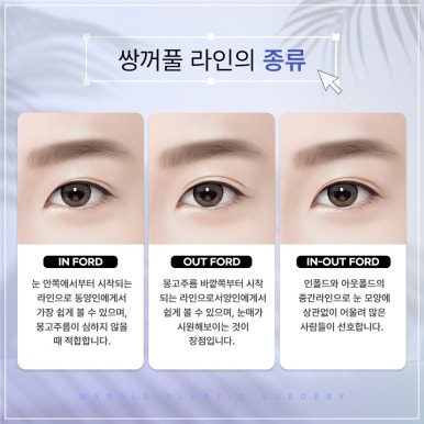 수능 끝나고 쌍수 시기, 고3 수험생 쌍꺼풀 수술 자연유착 방법 관련 이미지 7