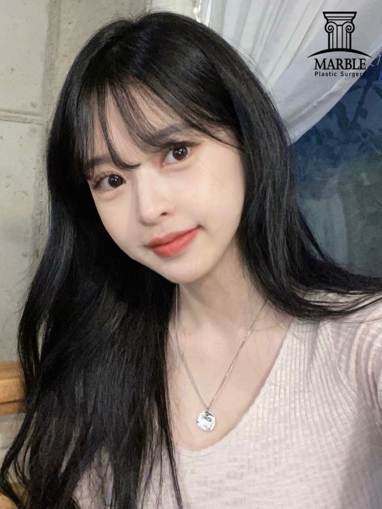 더 이상 쌍꺼풀재수술은 그만, 내 눈은 왜 잘 풀릴까? 관련 이미지 2