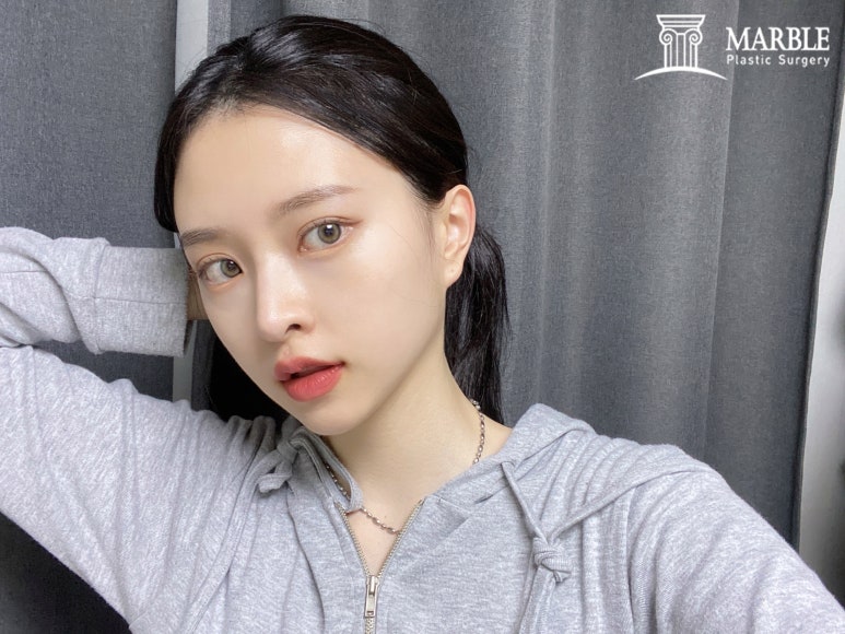 더 이상 쌍꺼풀재수술은 그만, 내 눈은 왜 잘 풀릴까? 관련 이미지 7
