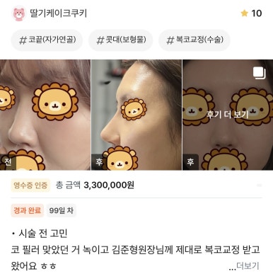 [강남성형외과 복코성형 후기] 각도 안 나오던 펑퍼짐한 코 모양.. 김준형 원장님 만나 정착했어요! 관련 이미지 1