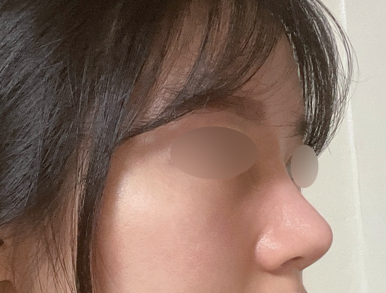 [Gangnam Station Plastic Surgery Clinic Bulbous Nose Rhinoplasty Review] My nose used to spread when I smiled and caused me stress... Now I’ve found the nose of my dreams! Haha image 6