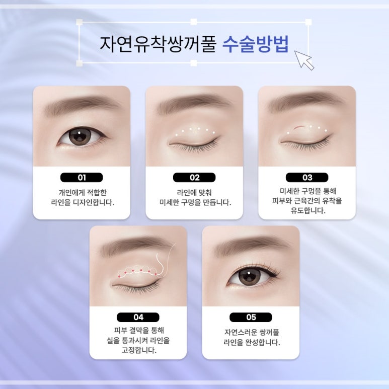 자연유착쌍꺼풀후기 눈매를 더욱 또렷하게 관련 이미지 13