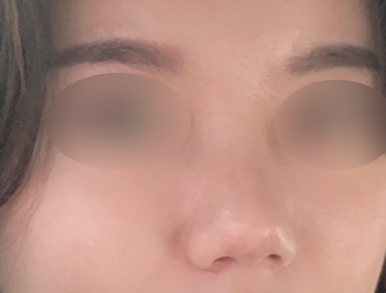 [Gangnam Station Plastic Surgery Clinic Bulbous Nose Rhinoplasty Review] My nose used to spread when I smiled and caused me stress... Now I’ve found the nose of my dreams! Haha image 3