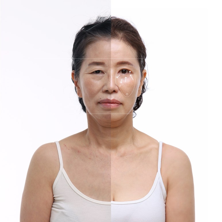 중년눈성형 잘 알아보고 해야 하는 이유? 관련 이미지 5