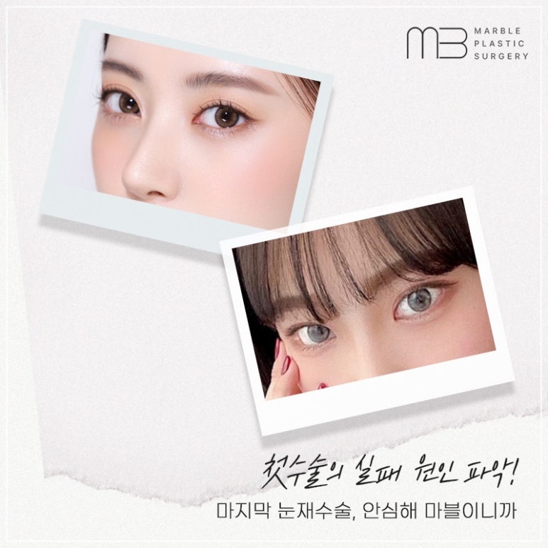 눈성형 눈재수술잘하는병원, 이렇게 준비하세요! 관련 이미지 5