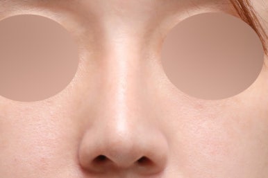 매부리코교정방법, 조화로운 코 라인의 핵심 관련 이미지 2