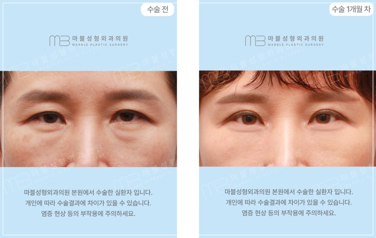 Differences in Lower Eyelid Surgery by Age Group and Recommended Methods: Showing Your Parents Appreciation Through Lower Eyelid Surgery (Before-and-After Photos O) @ Marble Plastic Surgery Clinic image 4