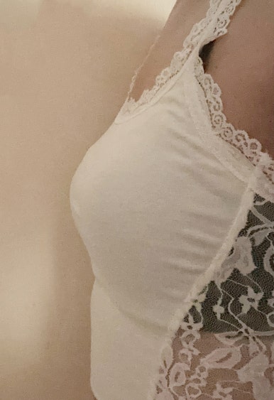 Different Texture and Volume After Breast Surgery with Motiva image 1