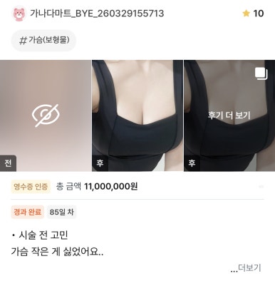[Gangnam Plastic Surgery Breast Surgery Review] I Didn't Need to Look Anywhere Else After Such a Detailed Consultation—Meeting Dr. Seo Il-beom Made My Wish Come True! image 1