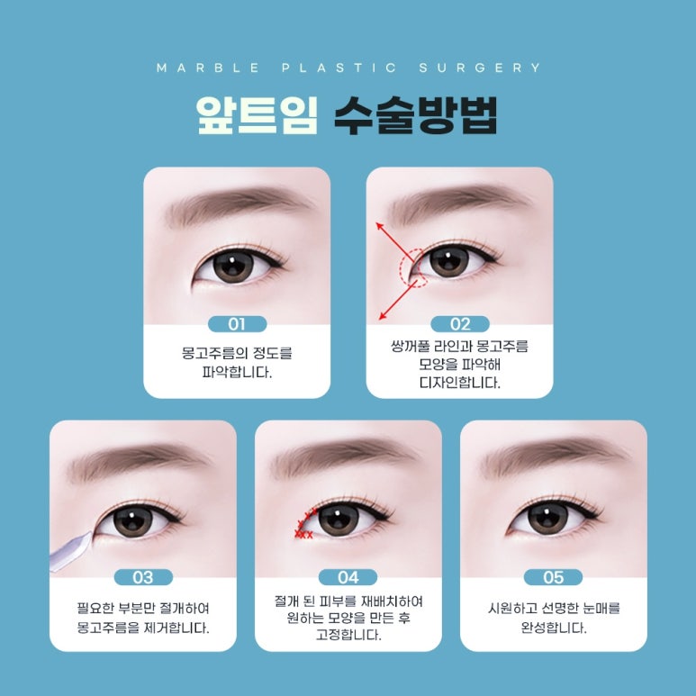 트임수술은 마블성형외과의원 관련 이미지 4