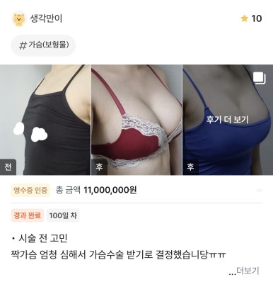 [강남성형외과 가슴성형 후기] 혼자 고민하던 비대칭 짝가슴.. 원장님의 체형 맞춤 진단으로 콤플렉스 극복! 관련 이미지 1