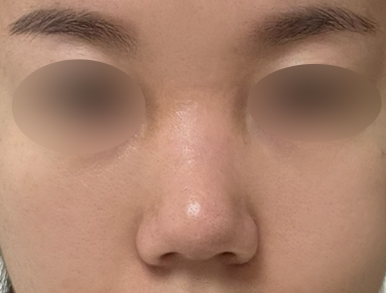 [Gangnam Station Plastic Surgery Clinic Bulbous Nose Rhinoplasty Review] My nose used to spread when I smiled and caused me stress... Now I’ve found the nose of my dreams! Haha image 4