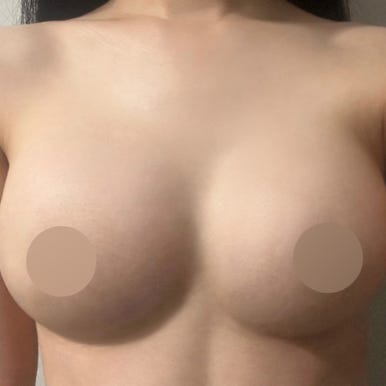 [강남역 성형외과 가슴수술 후기] 옷태 안 살던 빈약한 가슴ㅠㅠ 자연스러운 볼륨 생기고 고민 해결! 관련 이미지 7