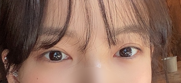 눈밑트임후기 부드러운 인상으로 변화 관련 이미지 1