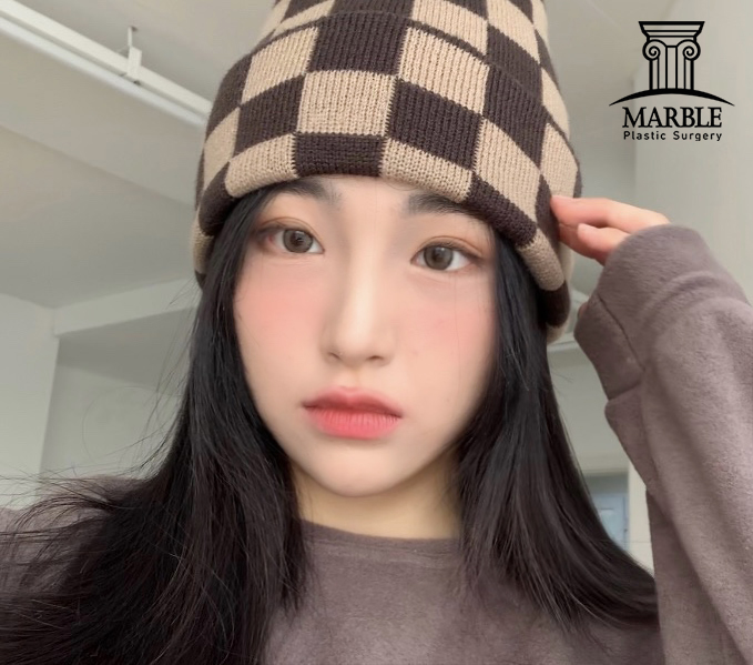 눈매교정 해야 하는 눈일까? 마블성형외과의원에서 알아보자! 관련 이미지 3
