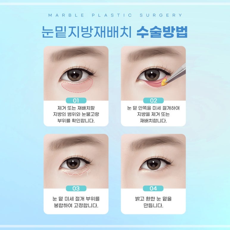 눈밑지방재배치수술 잘하는곳 찾는 기준 관련 이미지 4