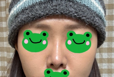 [Gangnam Plastic Surgery Rhinoplasty Review] My Short Nose Looked Upturned from the Front… Now It Has the Perfect Line with Postoperative Care Too! image 6