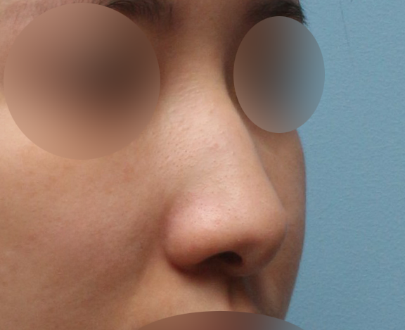 매부리코수술 전후 공개, 과하지 않게 교정한 리얼 경험 관련 이미지 2