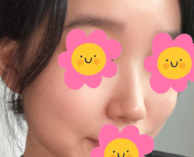 [Marble Plastic Surgery Nose Surgery Review] I Kept Worrying About My Hump Nose... I Should Have Had Surgery Sooner image 4