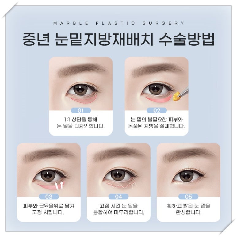 눈밑지방재배치 수술효과와 유지 기간: 정말 젊어 보일까? 관련 이미지 5