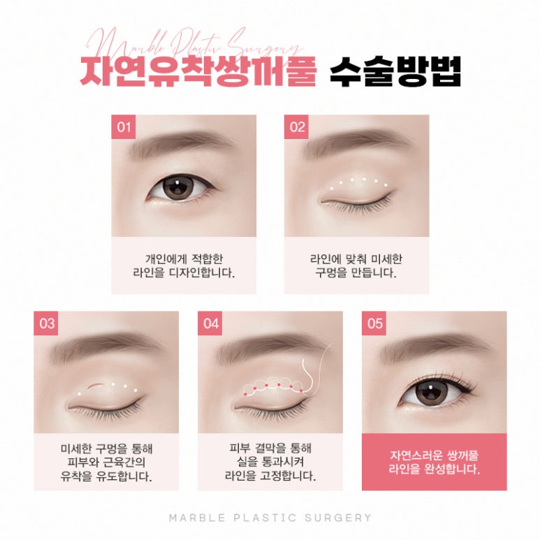 쌍꺼풀수술 고민될 때 반드시 확인해야할 것 관련 이미지 5