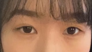 눈매교정부작용 벗어날 방법 알아보기 관련 이미지 1