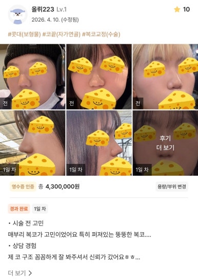[강남성형외과 매부리코성형 후기] 스트레스였던 매부리코.. 드디어 얄쌍하고 예쁜 코 라인 찾았어요ㅎㅎ 관련 이미지 1