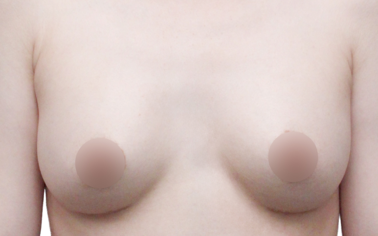 가슴재수술, 실패를 줄이기 위한 기준은? 관련 이미지 5