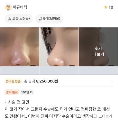 [Gangnam Plastic Surgery Clinic Rhinoplasty Revision Review] No matter how many surgeries I had, my nose still looked flat and wide... Now it has finally settled into a beautiful shape haha image 1