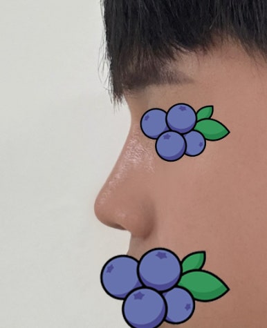 [강남성형외과 매부리코수술 후기] 울퉁불퉁한 옆 라인 고민.. 자가늑 덕분에 또렷한 콧대로 변신했어요! 관련 이미지 8