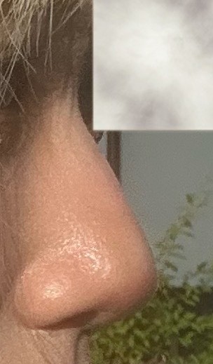 [Gangnam Plastic Surgery Hump Nose Surgery Review] The Bulky, Humped Nose That Looked Thick... A Refined Impression Achieved Without an Implant, haha image 3
