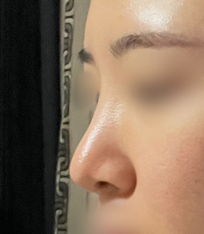 [마블성형외과 코성형 후기] 코수술 한 티도 안 나던 뭉툭한 복코... 재수술로 드디어 정착했어요ㅠㅠ 관련 이미지 4