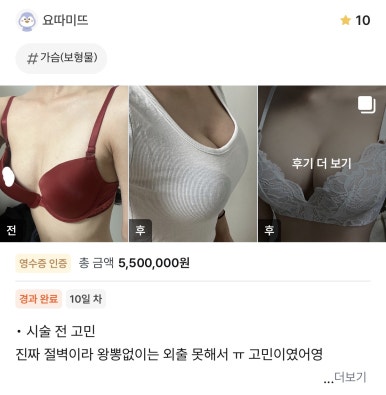 [Breast Surgery Review at a Gangnam Plastic Surgery Clinic] 70A Was So Small That My Uneven Breasts Stressed Me Out... I Got My Dream Boobs with Mentor Extra! Haha image 1