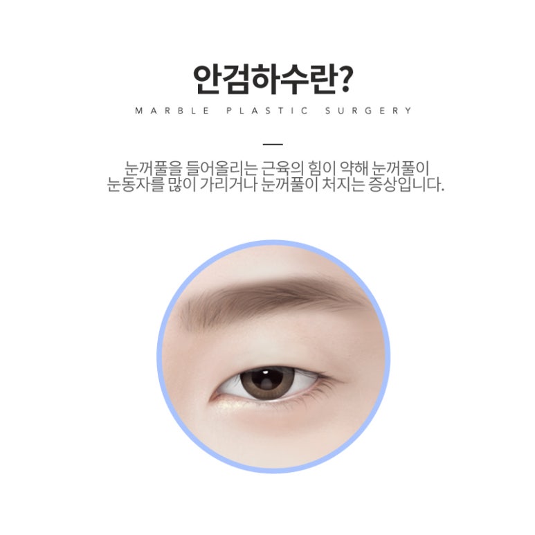 눈매교정 부작용 무엇이 있을까? 관련 이미지 3