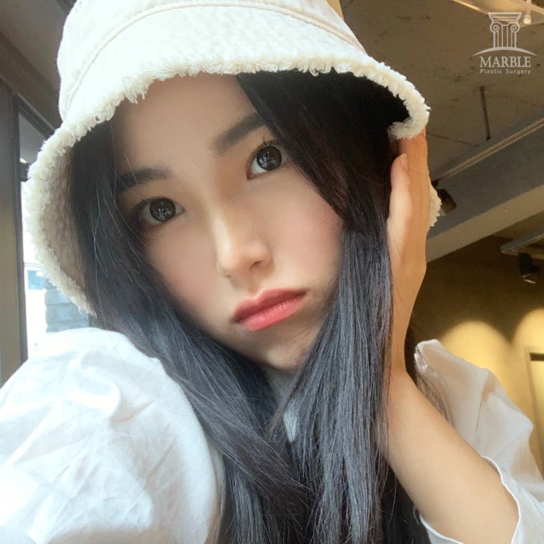 쌍수전후 달라진 눈매 기대한다면 관련 이미지 1