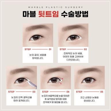 눈성형잘하는병원, 쌍꺼풀수술, 트임수술 관하여 관련 이미지 12