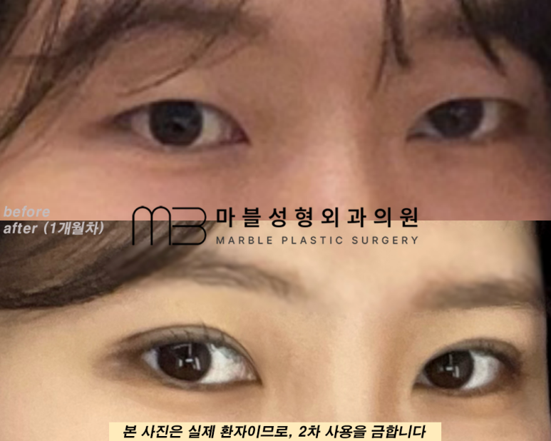 자연유착쌍꺼풀후기 눈매를 더욱 또렷하게 관련 이미지 8