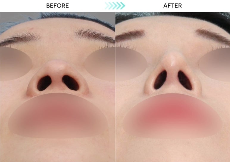 [First Rhinoplasty] Three Months After Hump Nose Correction: The Standard Approach to Nasal Tip Osteotomy and Hump Nose Correction image 6