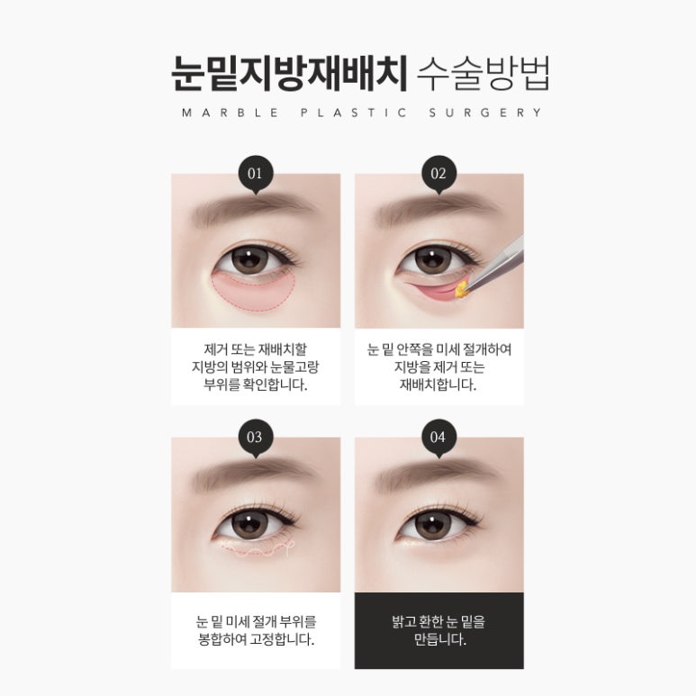 눈밑지방재배치 칙칙한 인상은 그만! 관련 이미지 5