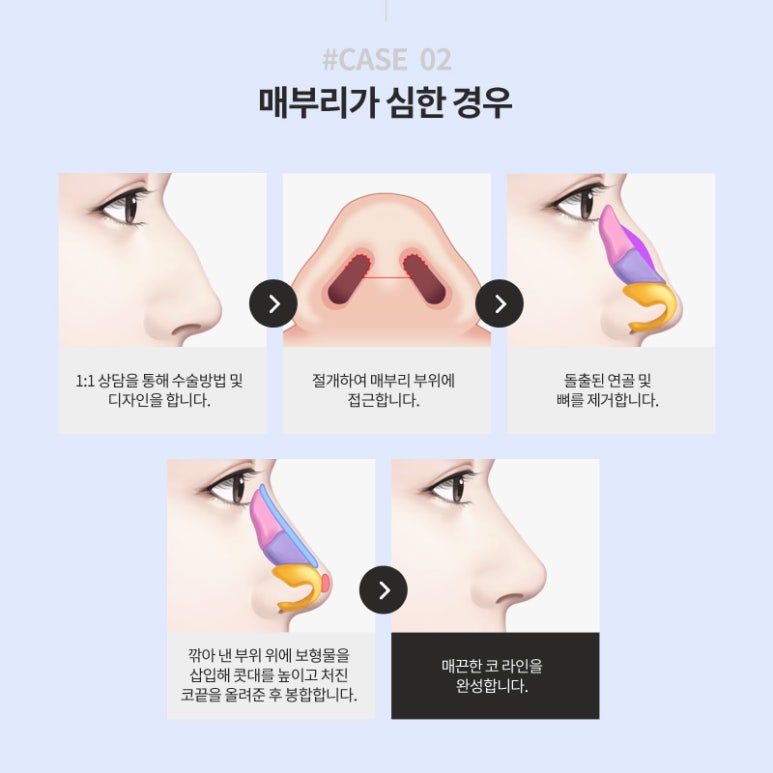 매부리코 성형, 매끄러운 코 라인 마블성형외과의원 관련 이미지 6