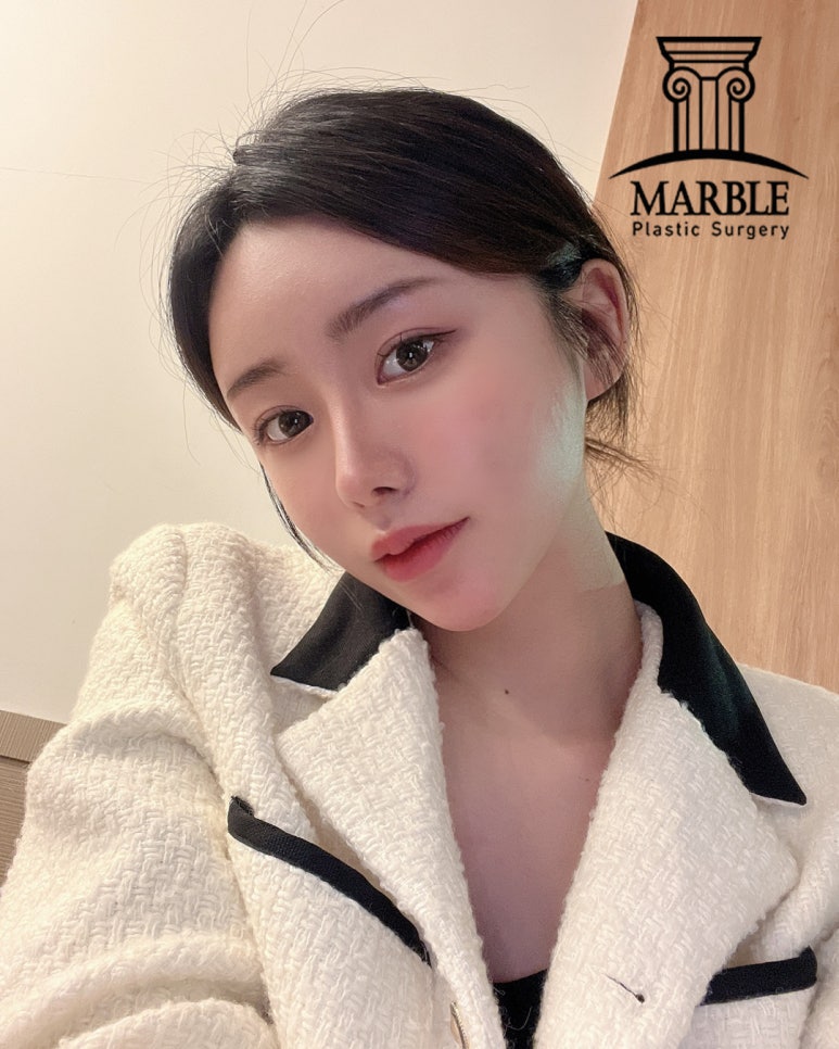 눈재수술, 반복되지 않으려면 마블성형외과의원에서! 관련 이미지 4