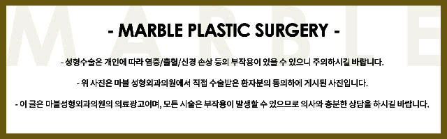 쌍수매몰 알아야 할 사실들 마블성형외과의원 관련 이미지 9