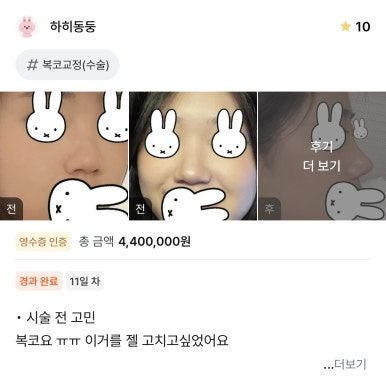 [강남성형외과 복코성형 후기] 두꺼운 피부라 얄쌍해지기 어렵다던 제 복코.. 지금은 콧볼까지 얇아졌어요 관련 이미지 1