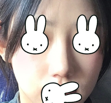 [강남성형외과 복코성형 후기] 두꺼운 피부라 얄쌍해지기 어렵다던 제 복코.. 지금은 콧볼까지 얇아졌어요 관련 이미지 8