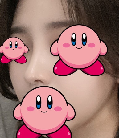[강남역성형외과 복코수술 후기] 빡센 다이어트도 소용없던 복코.. 아이돌 코로 다시 태어났어요! 관련 이미지 8