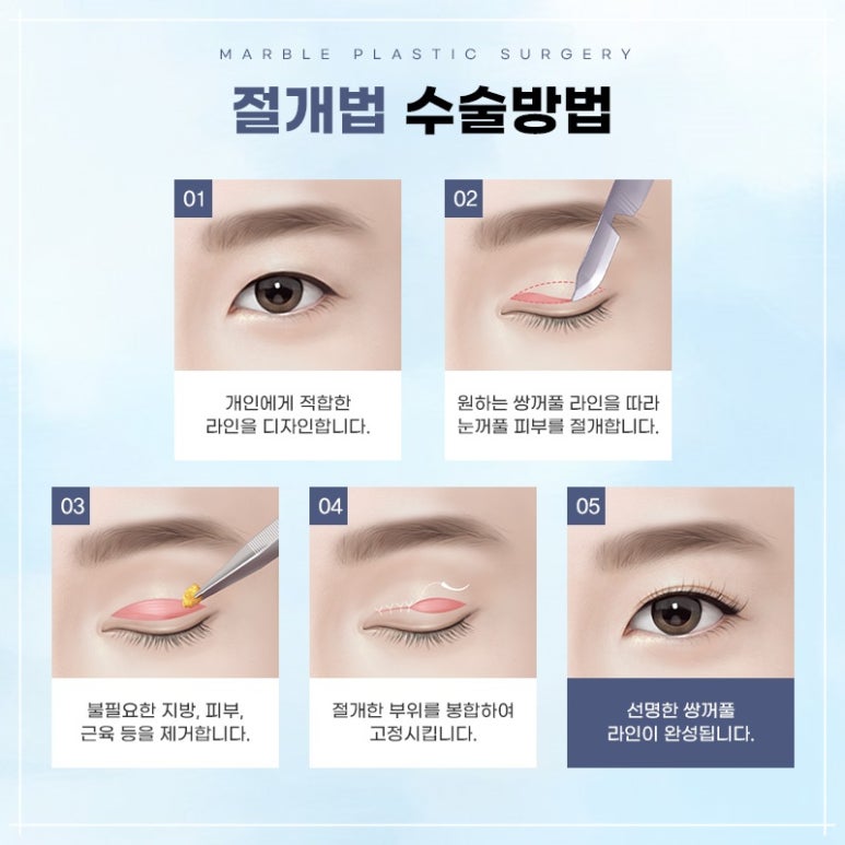 눈성형 전후 전문 병원 정보 및 선택의 기준 관련 이미지 5