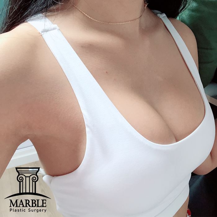 가슴성형부작용 예방하려면 어떻게? 마블성형외과의원 관련 이미지 7