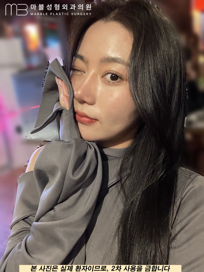 자연유착쌍꺼풀후기 눈매를 더욱 또렷하게 관련 이미지 2